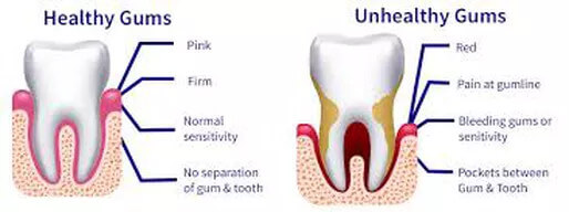 Safety Bay Dental Care Centre Dental - Dental Health - Healthy Gums vs Unhealthy Gums