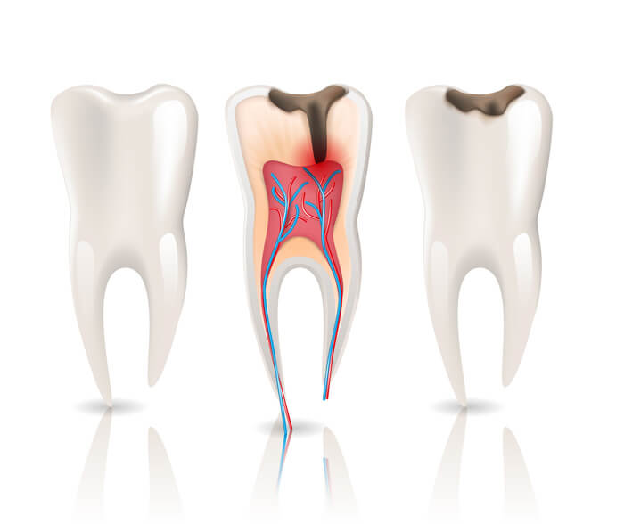 Safety Bay Dental Care Centre Dental Services - Rooth Canals Therapies - Root Canal Cross Section